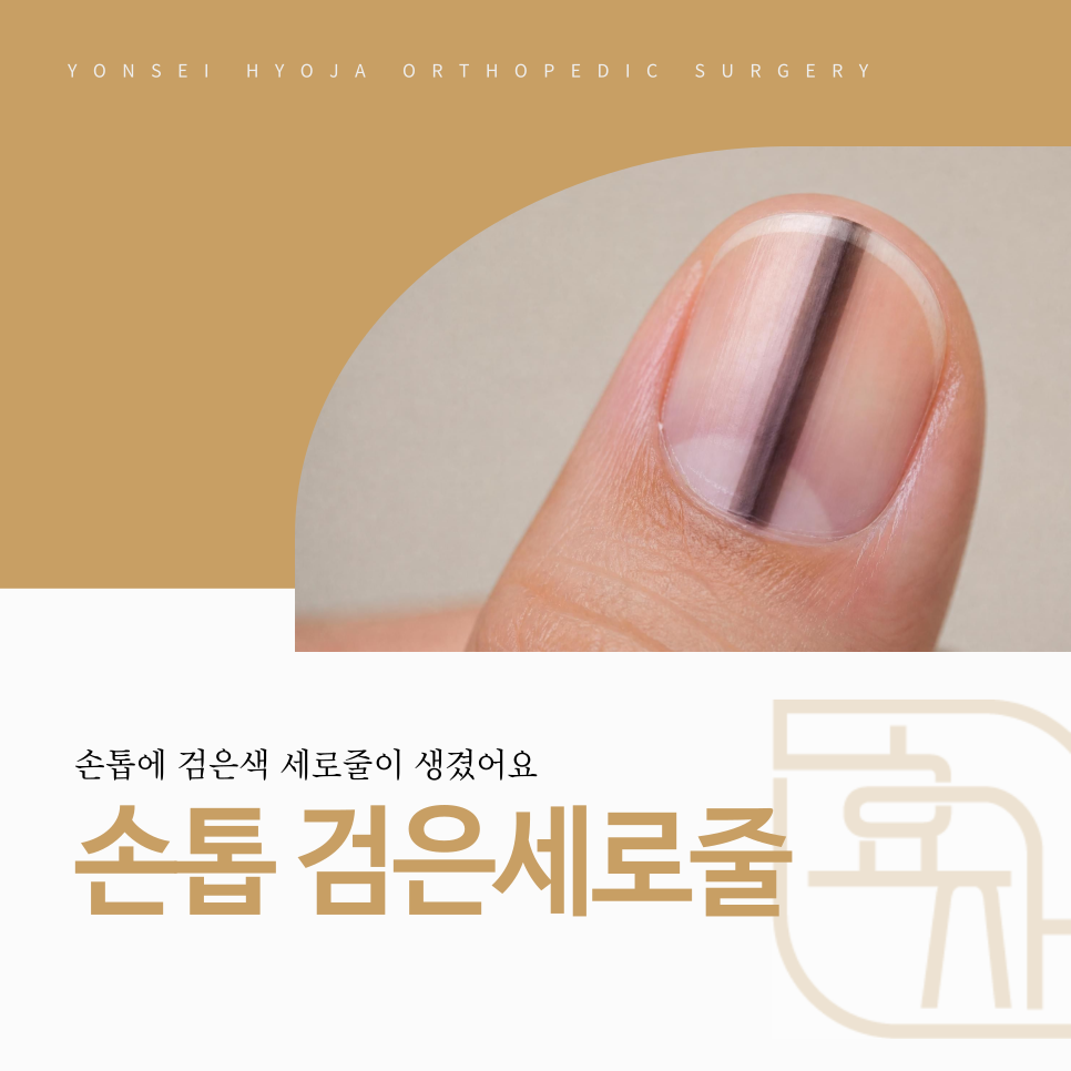 까치산역 손톱 검정세로줄 흑색조 원인 감별 흑색종 정밀 검사